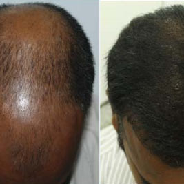 Hair Transplant Clinic in Bangalore | Hair Transplant Cost