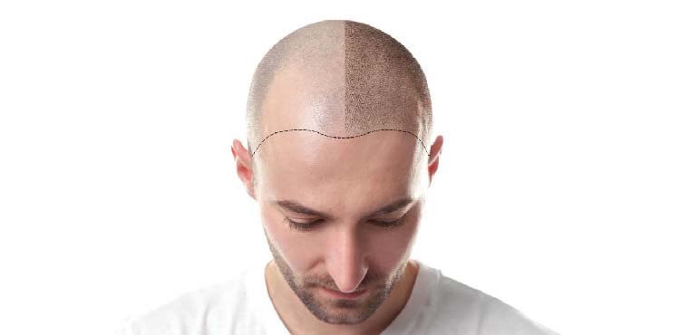 Hair Transplant Clinic in Bangalore | Hair Transplant Cost